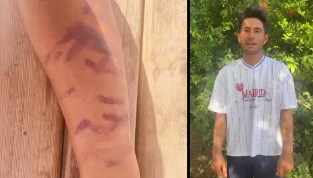 lazer epilasyon yaptirdigi merkezde kabus yasadi ben yandim baskalari yanmasin bFupqayH.jpg